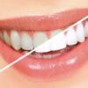 Teeth Whitening Options