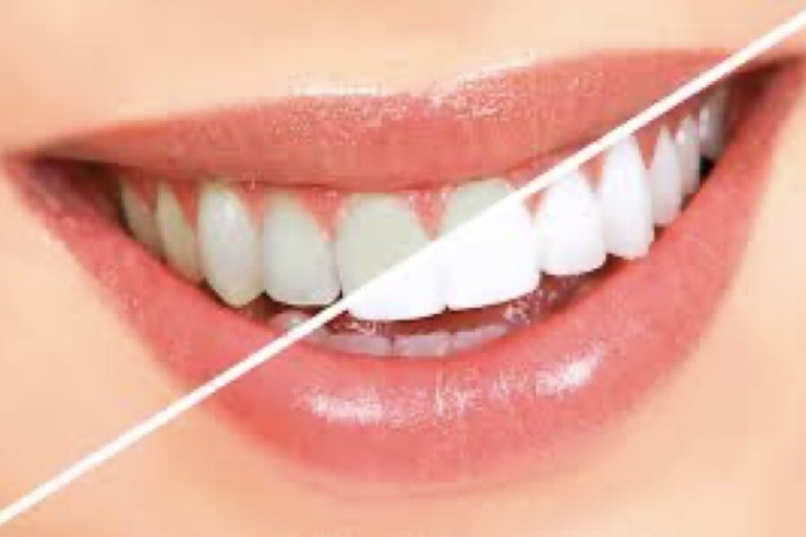 Teeth Whitening Options