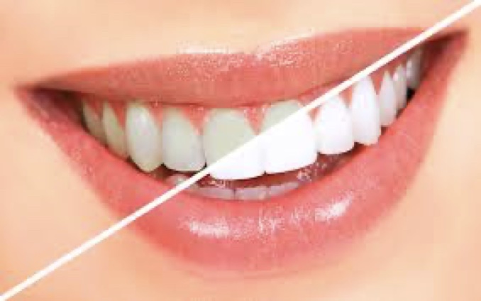 Teeth Whitening Options