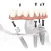 Full Arch Dental Implants (AOX)