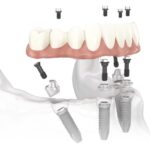 dental implants, Mountain View, CA dentist