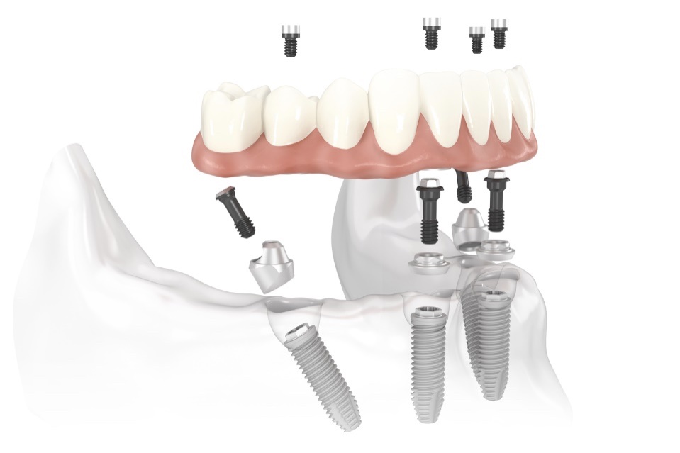 Full Arch Dental Implants (AOX)